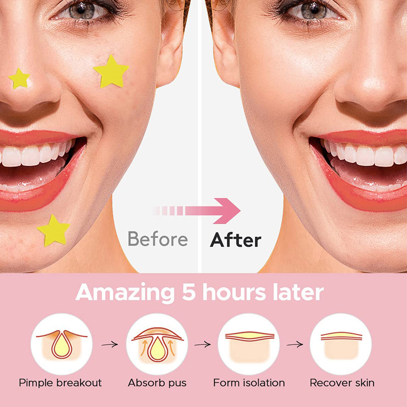 600 adet/takım Yıldız Sivilce  - Beauty Makeup Tool incelemesi ve fiyatı